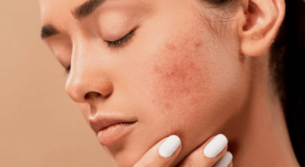 Skin Problems