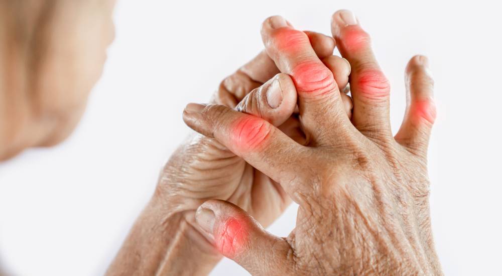 Arthritis / Joint Related Disease