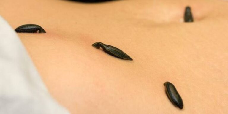 Rakta Mokshan Ayurvedic Treatment in Pune